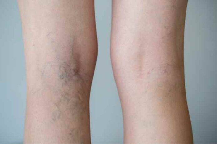 All You Need To Know About Varicose Vein Treatment